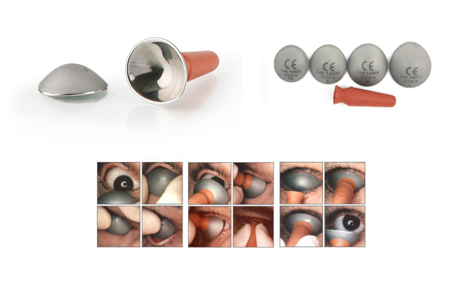 Stainless steel intraocular laser shield